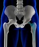 Hip Replacement Devices.  Are They Safe?