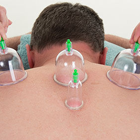 cupping-therapy-depositphotos-