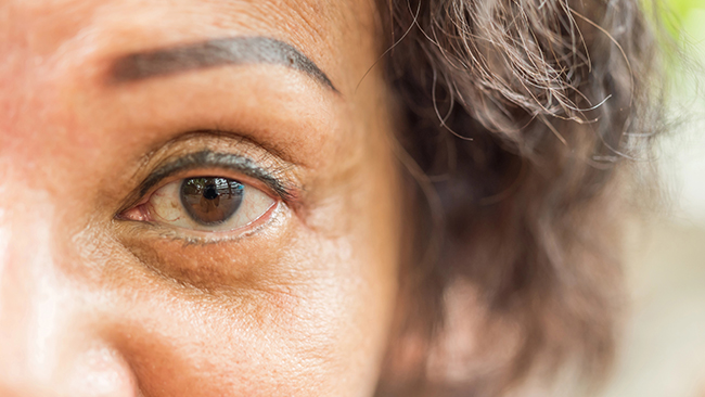 sufferers of dry eye